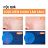Hiệu quả sử dụng Sữa rửa mặt ngừa mụn Neutrogena Deep Clean Acne Foaming Cleanser 100g
