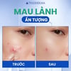 Trước và sau khi sử dụng Miếng dán mụn Rejuvaskin Trioderma Day & Night