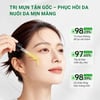 Hiệu quả sử dụng Serum giảm mụn LUCENBASE 2% Supramolecular Salicylic Acid Anti Acne 30ml
