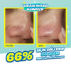 Trước và sau khi sử dụng Dung dịch làm mềm mụn đầu đen JUMISO Blackhead Melting Softener 150ml
