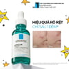 Hiệu quả sử dụng Serum giảm mụn La Roche-Posay Effaclar Serum 30ml