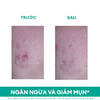 Trước và sau khi sử dụng Kem ngừa mụn Uriage Hyseac 3-Regul Soin Global 40ml