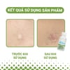 Kết quả sử dụng Chấm mụn Bye Bye Blemish Tea Tree Drying Lotion