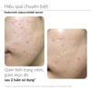 Hiệu quả Tinh chất giảm mụn Ekseption Hyaluronic ZnPCA