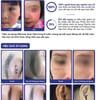 Hiệu quả sử dụng Gel xóa sẹo Rejuvaskin Rejuvasil Silicone Scar Gel