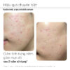 Hiệu quả Tinh chất giảm mụn Ekseption Hyaluronic ZnPCA